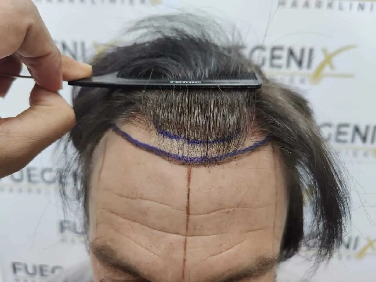 Before – From Failed Hair Transplant To Shah Rukh Khan
