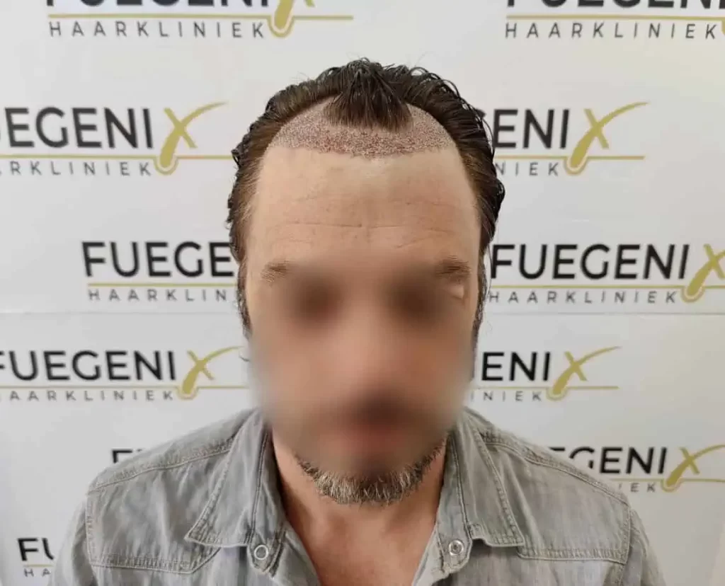 From Failed Hair Transplant To Shah Rukh Khan