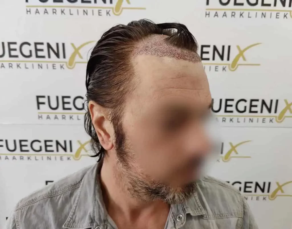 From Failed Hair Transplant To Shah Rukh Khan