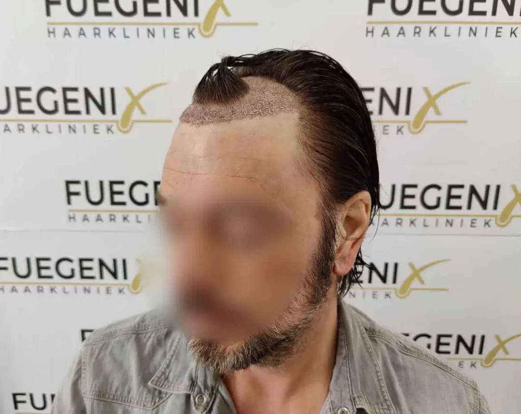 From Failed Hair Transplant To Shah Rukh Khan