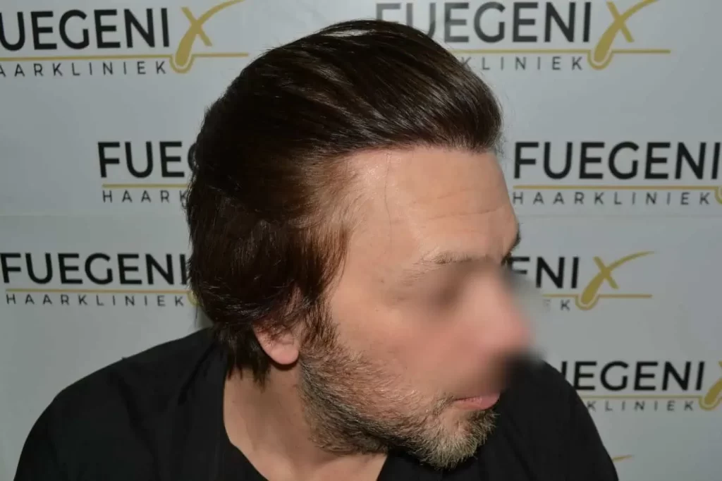From Failed Hair Transplant To Shah Rukh Khan