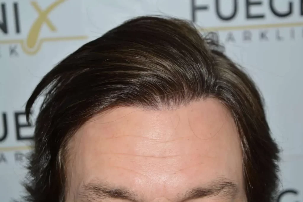 From Failed Hair Transplant To Shah Rukh Khan