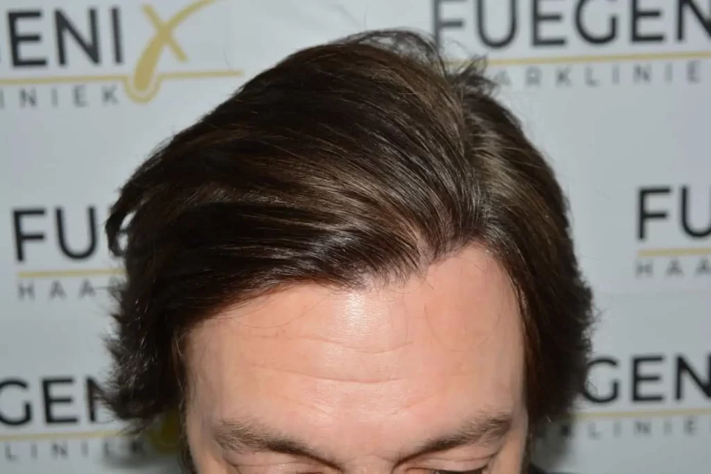 From Failed Hair Transplant To Shah Rukh Khan