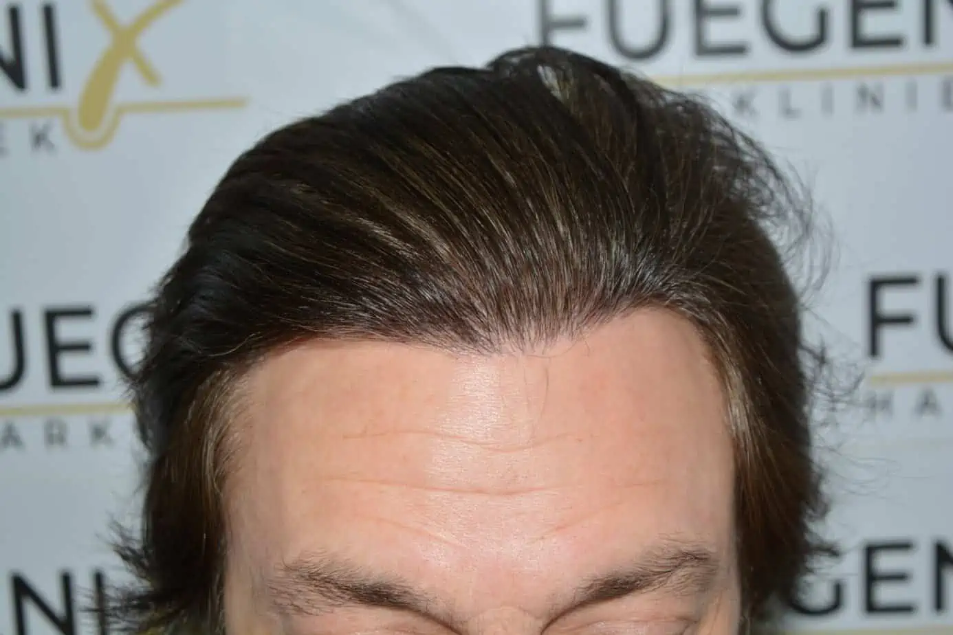 After – From Failed Hair Transplant To Shah Rukh Khan