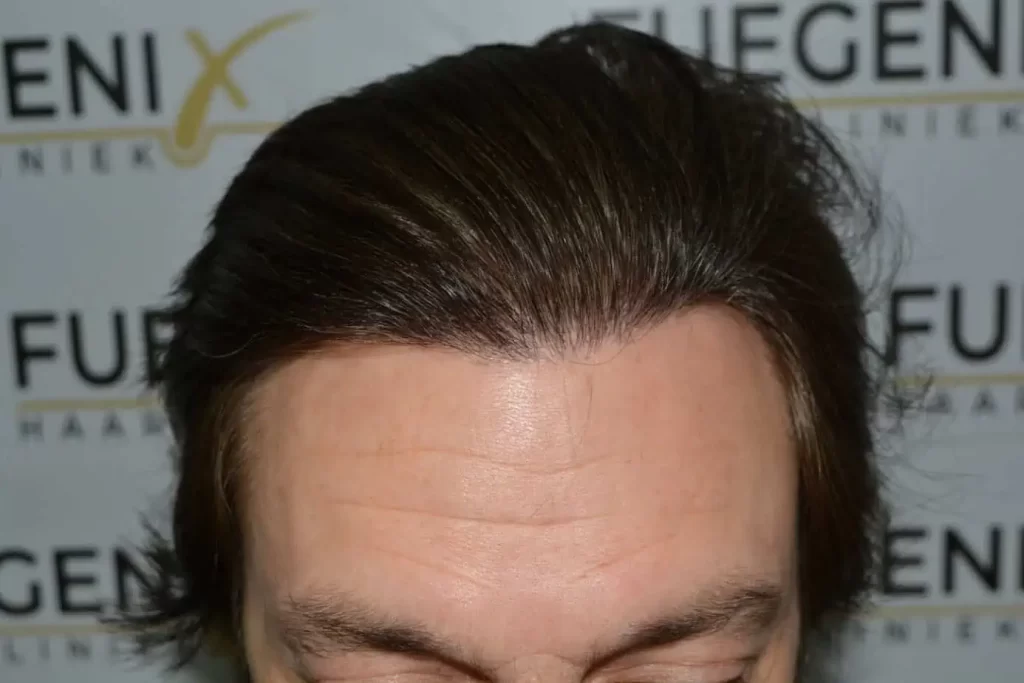 From Failed Hair Transplant To Shah Rukh Khan