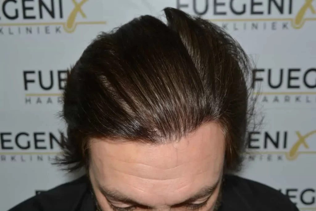 From Failed Hair Transplant To Shah Rukh Khan