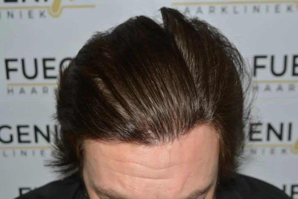 From Failed Hair Transplant To Shah Rukh Khan