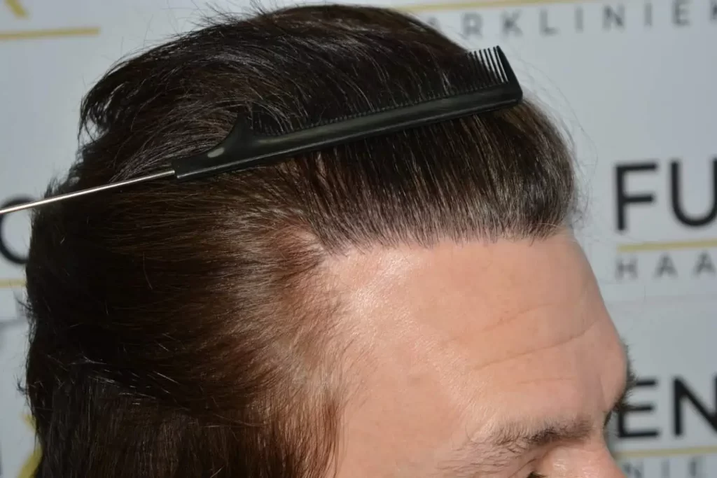 From Failed Hair Transplant To Shah Rukh Khan