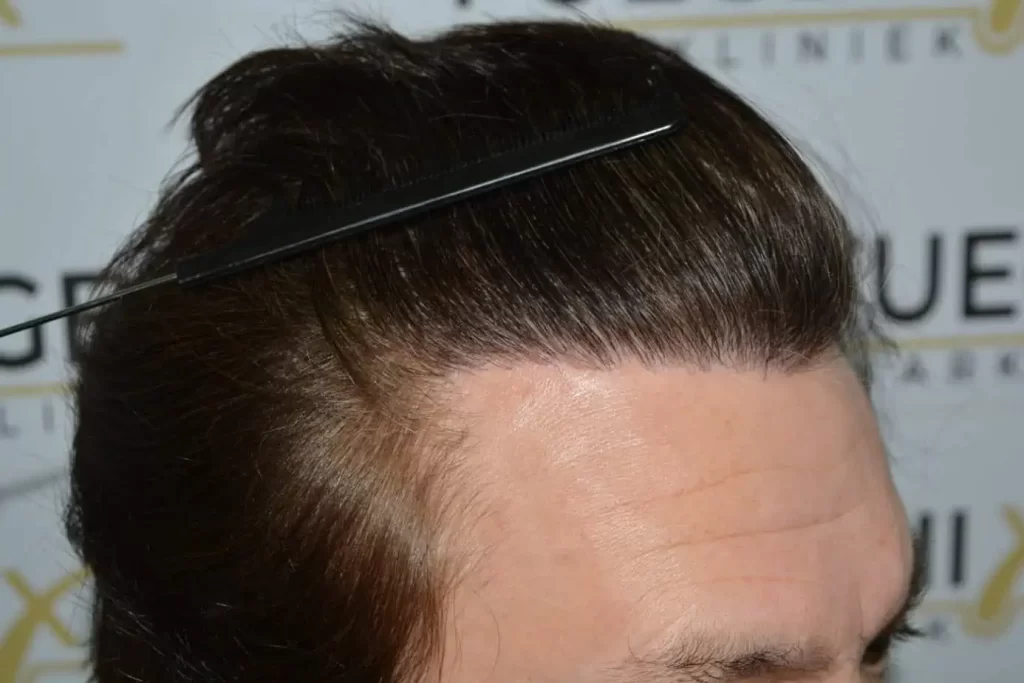 From Failed Hair Transplant To Shah Rukh Khan