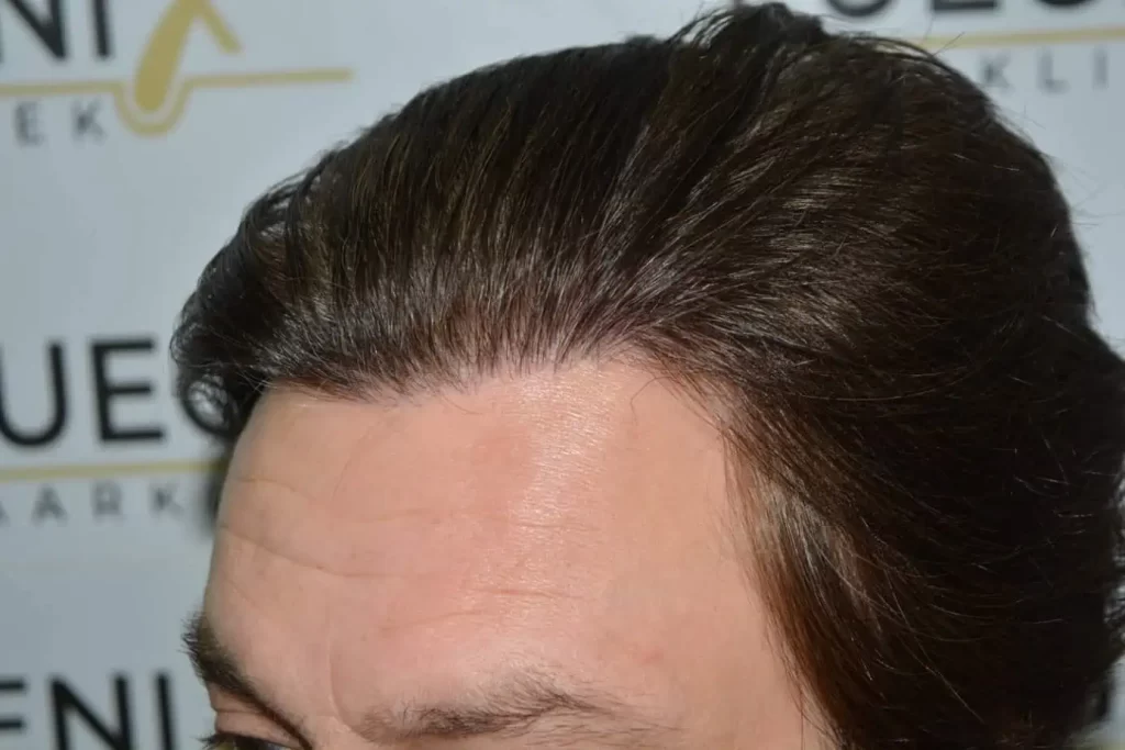 From Failed Hair Transplant To Shah Rukh Khan