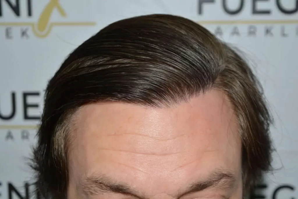 From Failed Hair Transplant To Shah Rukh Khan