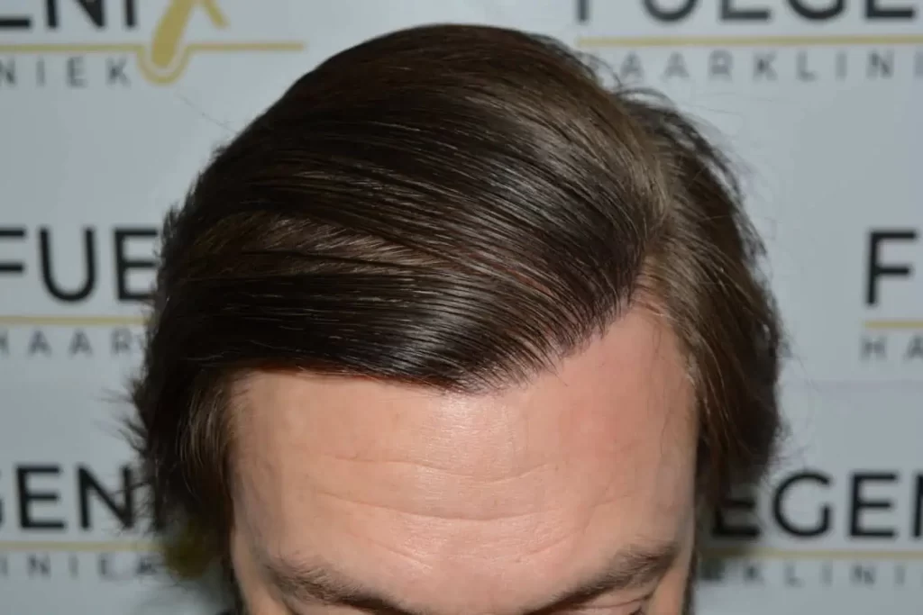 From Failed Hair Transplant To Shah Rukh Khan