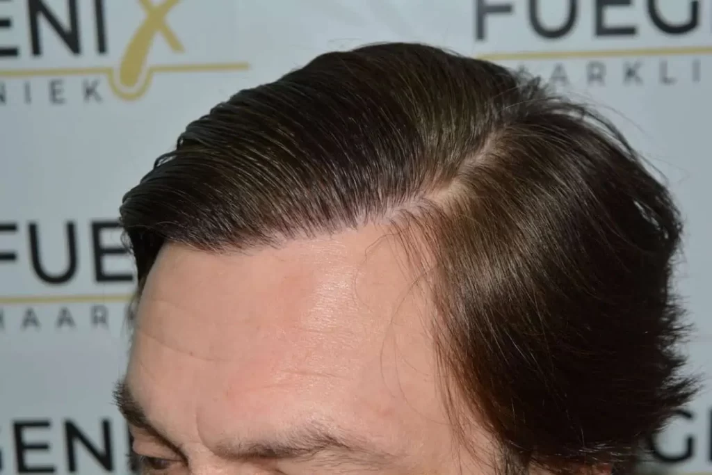 From Failed Hair Transplant To Shah Rukh Khan