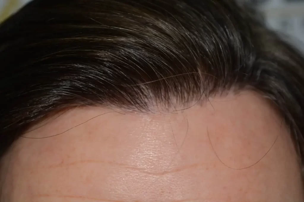 From Failed Hair Transplant To Shah Rukh Khan