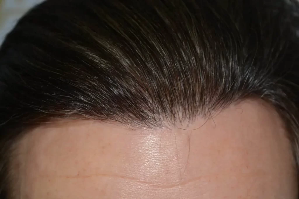 From Failed Hair Transplant To Shah Rukh Khan
