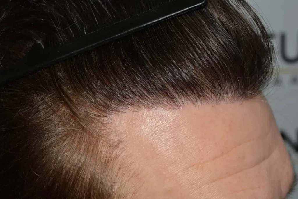 From Failed Hair Transplant To Shah Rukh Khan
