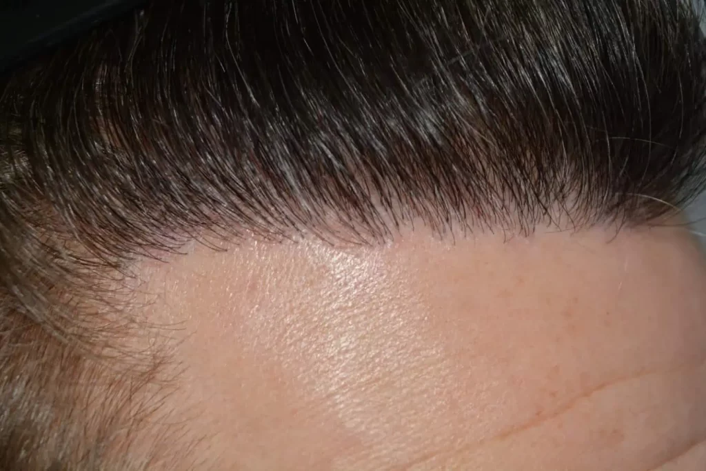 From Failed Hair Transplant To Shah Rukh Khan
