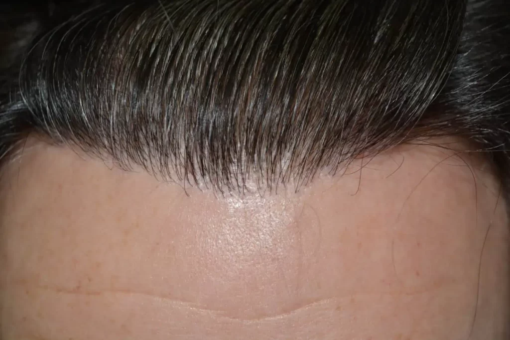From Failed Hair Transplant To Shah Rukh Khan