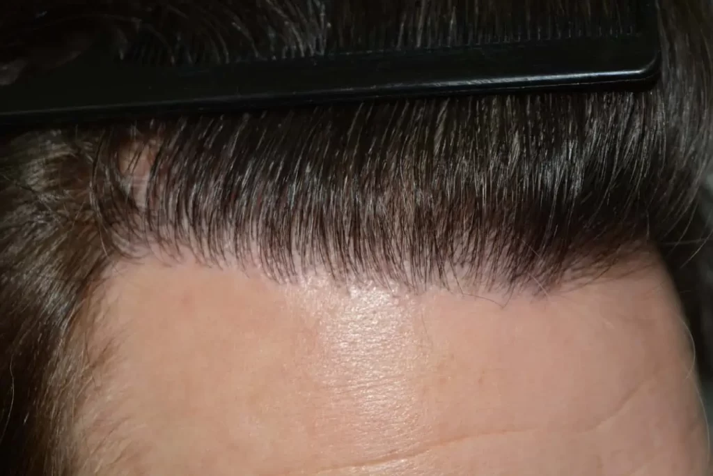 From Failed Hair Transplant To Shah Rukh Khan