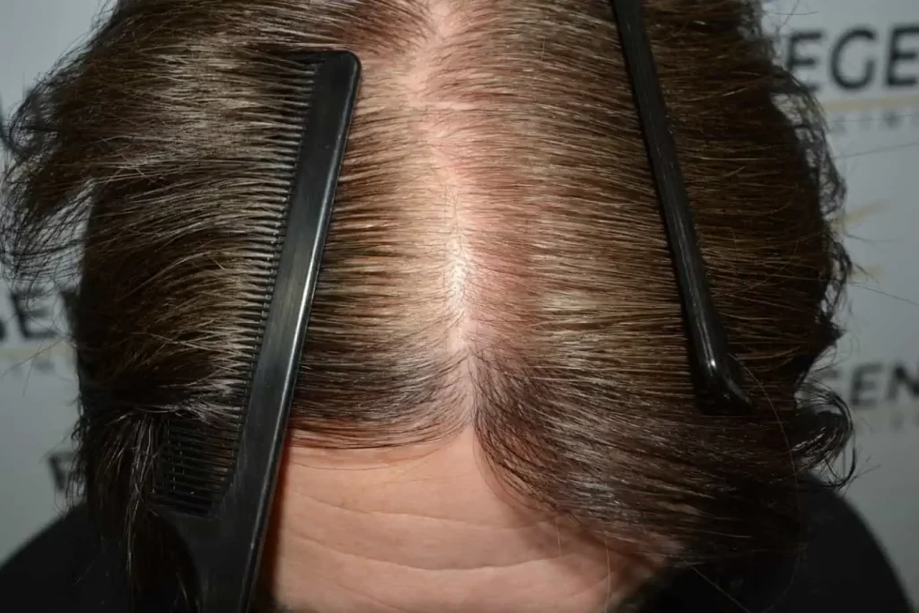 From Failed Hair Transplant To Shah Rukh Khan