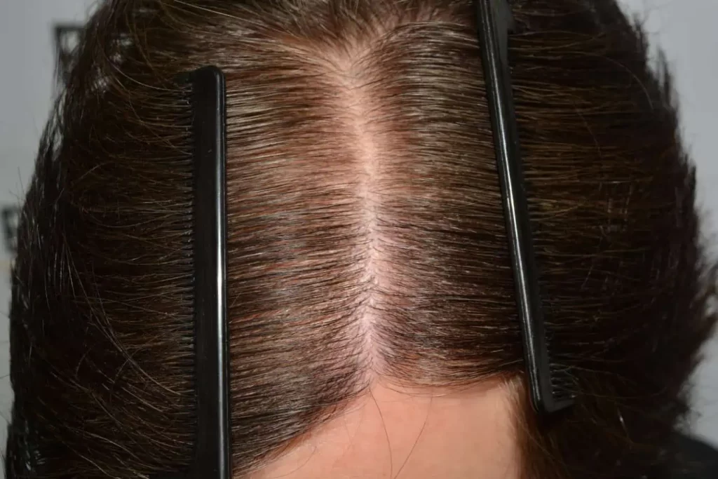 From Failed Hair Transplant To Shah Rukh Khan