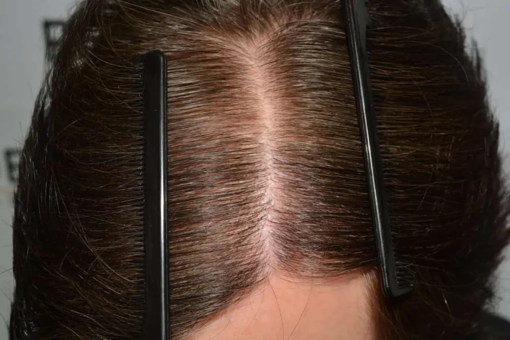 From Failed Hair Transplant To Shah Rukh Khan