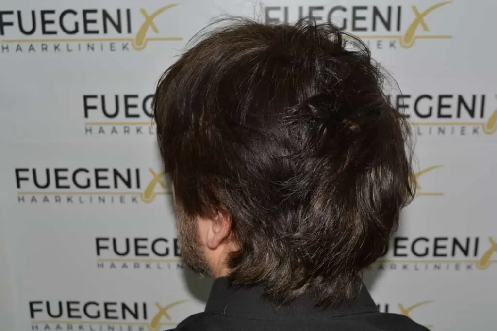From Failed Hair Transplant To Shah Rukh Khan