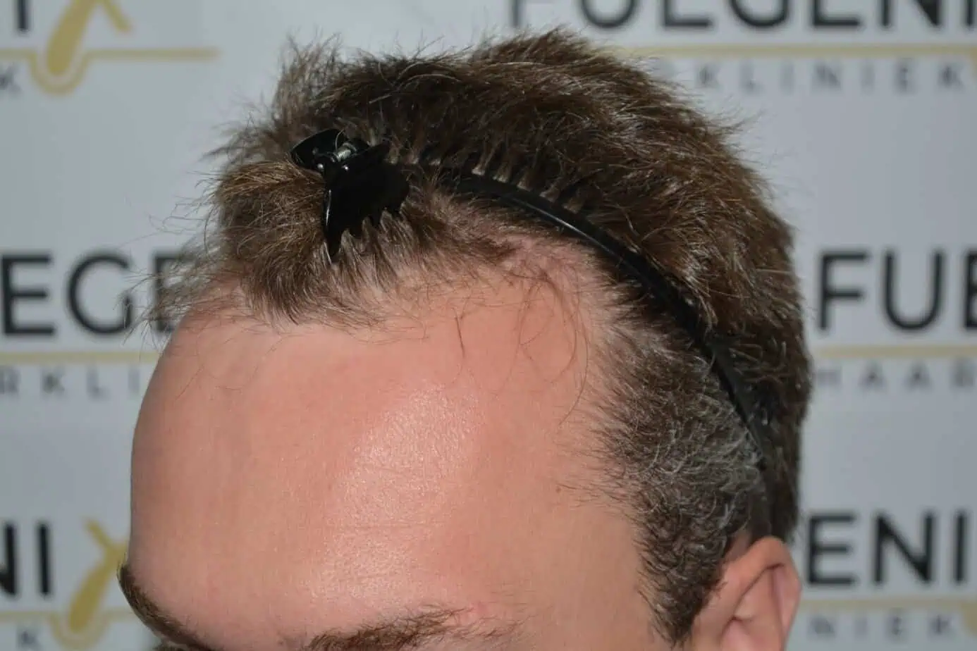 Before – From Hat Damon To Mat Damon