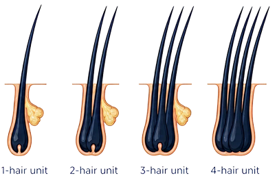 Hair graft units illustration