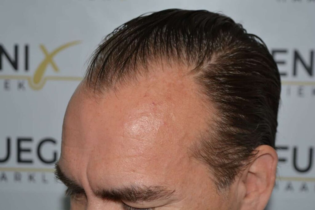 Hairline Artistry At Its Best