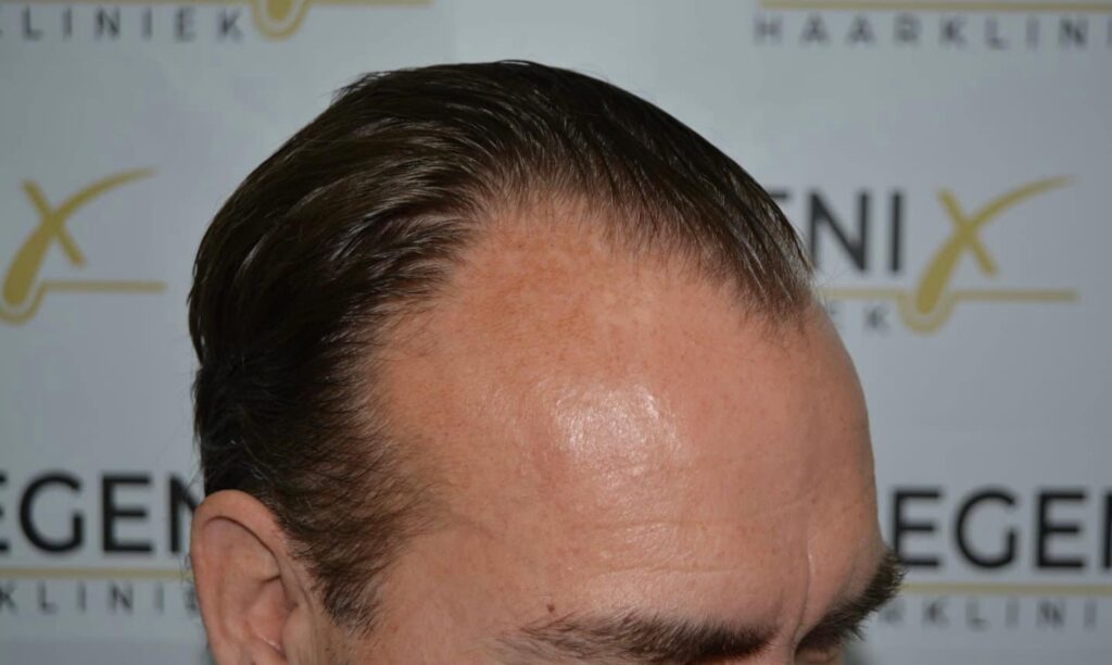 Hairline Artistry At Its Best