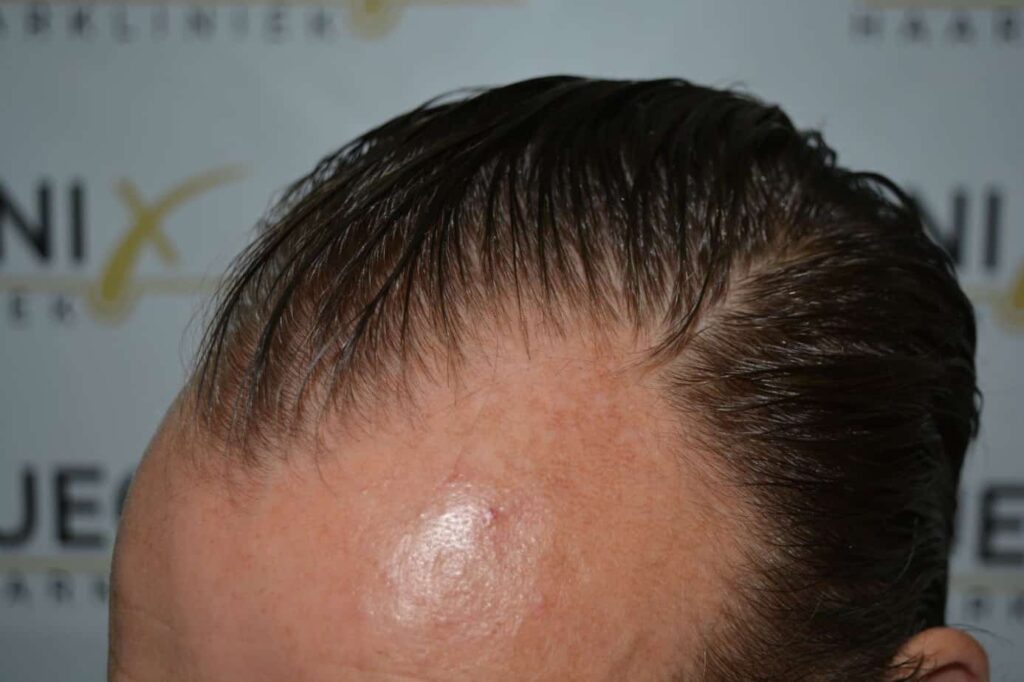 Hairline Artistry At Its Best