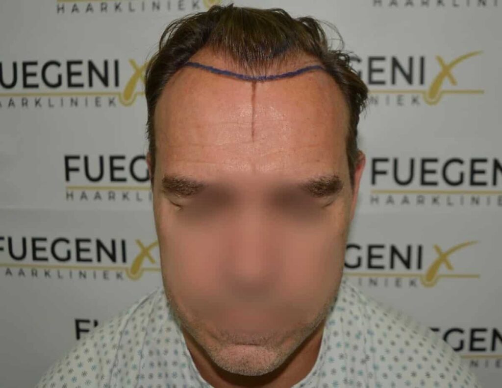 Hairline Artistry At Its Best