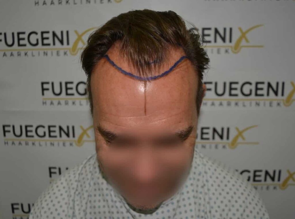 Hairline Artistry At Its Best