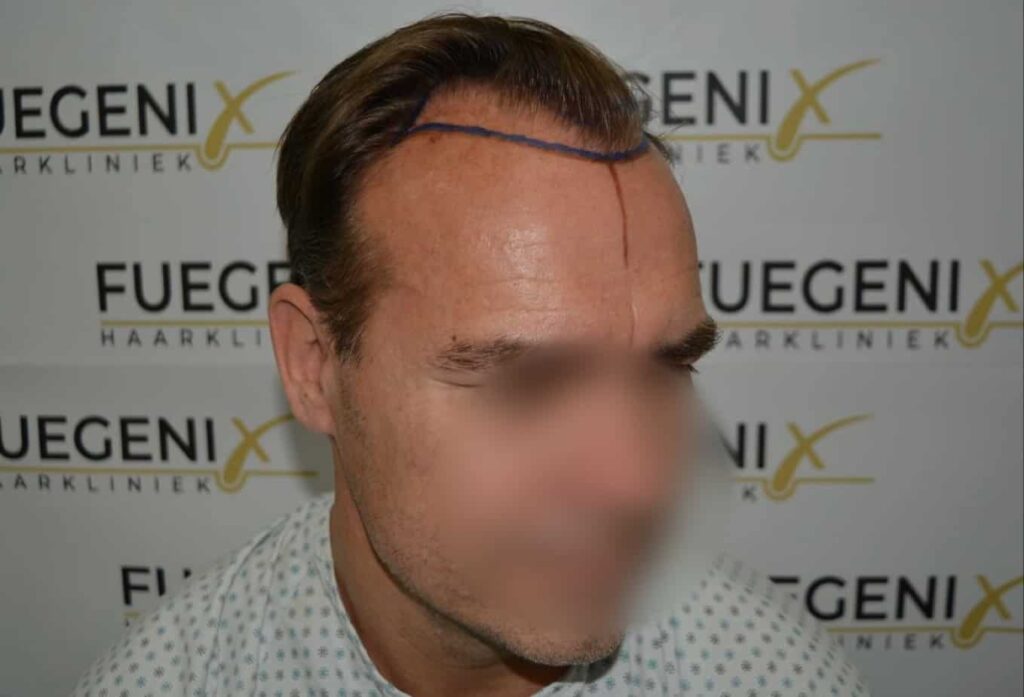 Hairline Artistry At Its Best