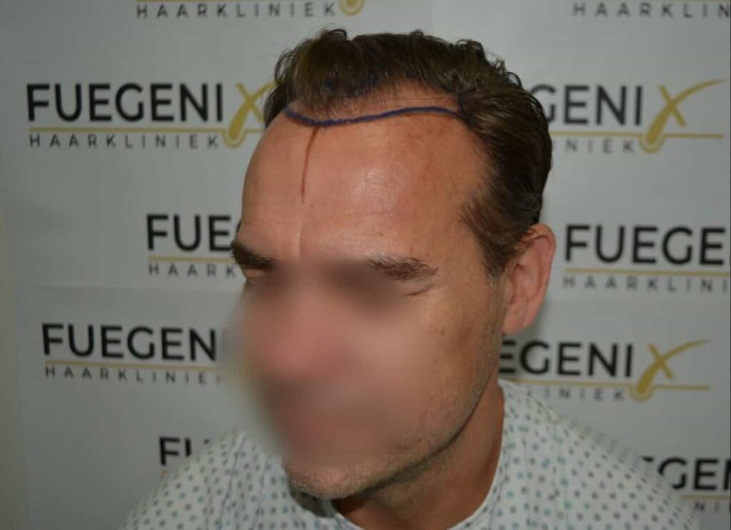 Hairline Artistry At Its Best