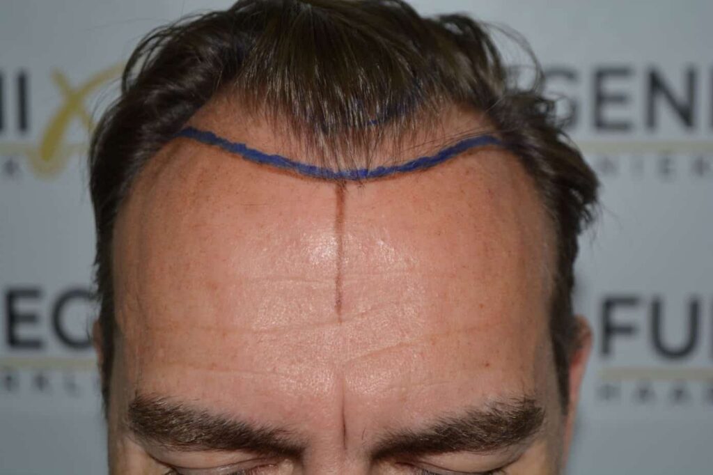 Hairline Artistry At Its Best