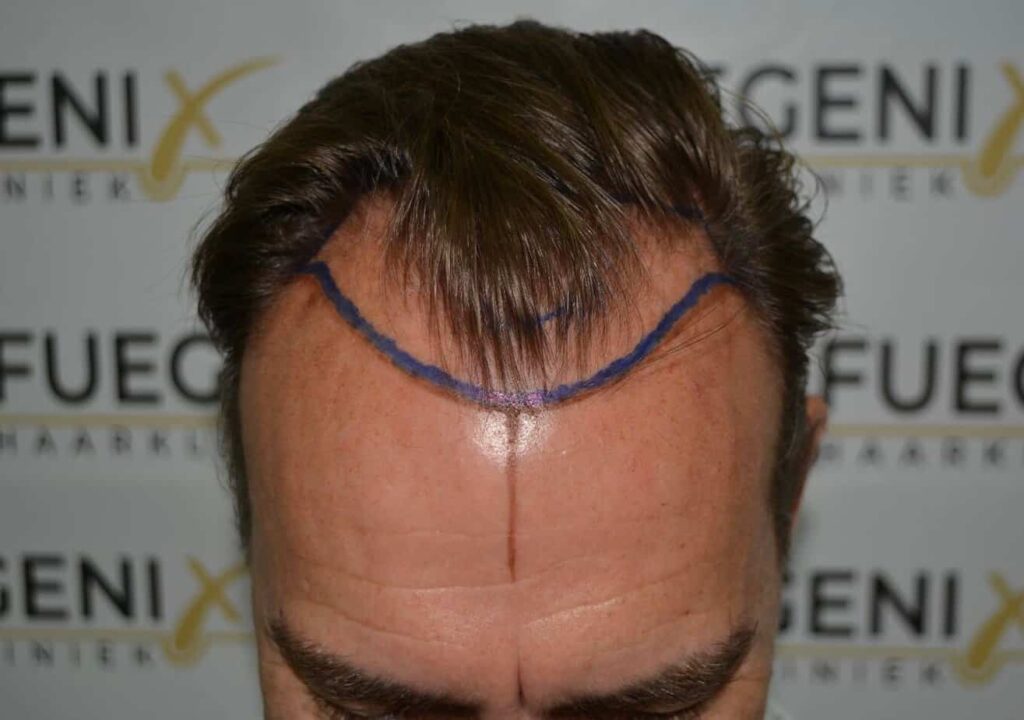 Hairline Artistry At Its Best