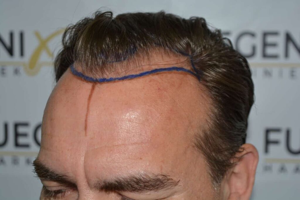Hairline Artistry At Its Best