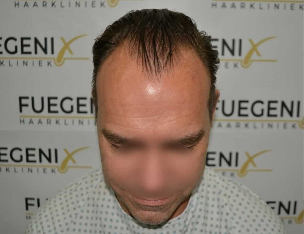 Hairline Artistry At Its Best