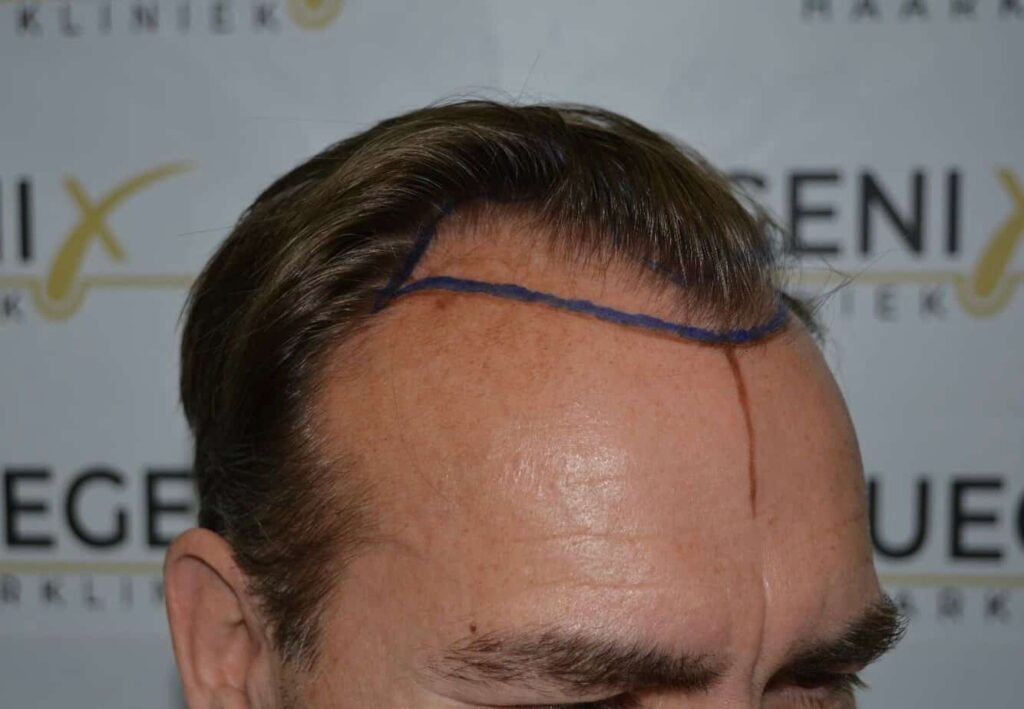 Hairline Artistry At Its Best