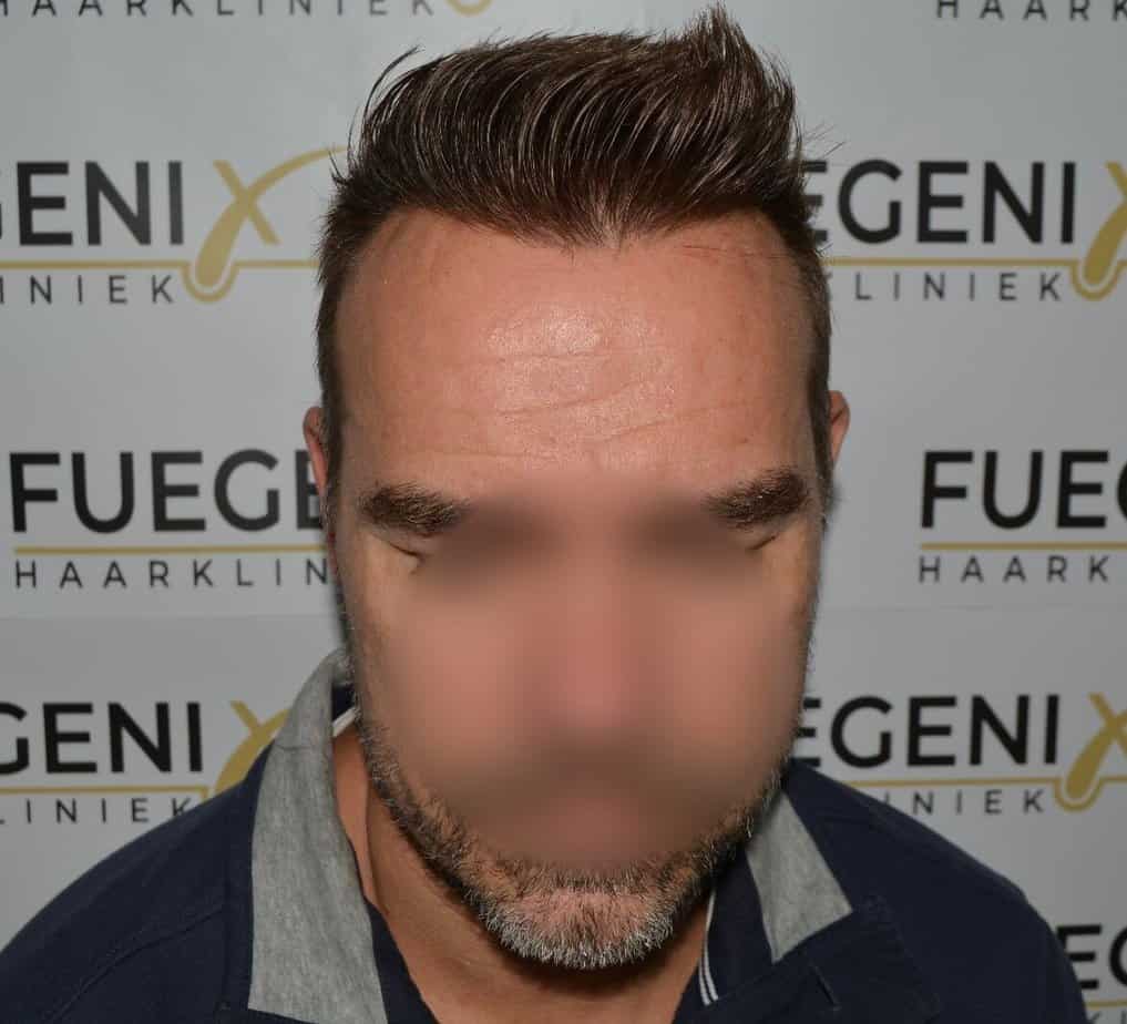 Hairline Artistry At Its Best