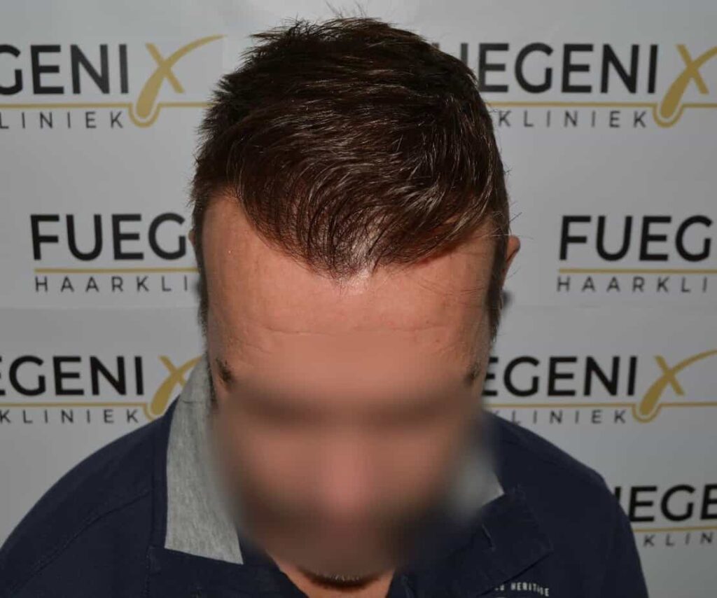 Hairline Artistry At Its Best