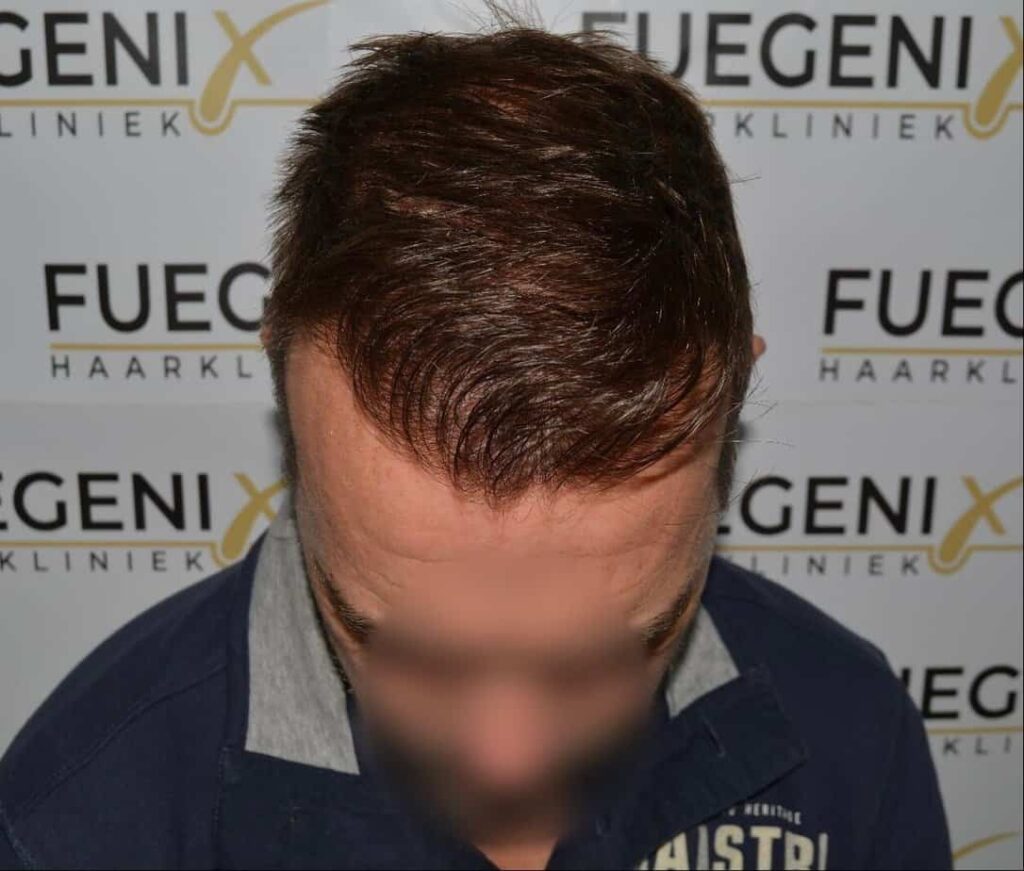 Hairline Artistry At Its Best