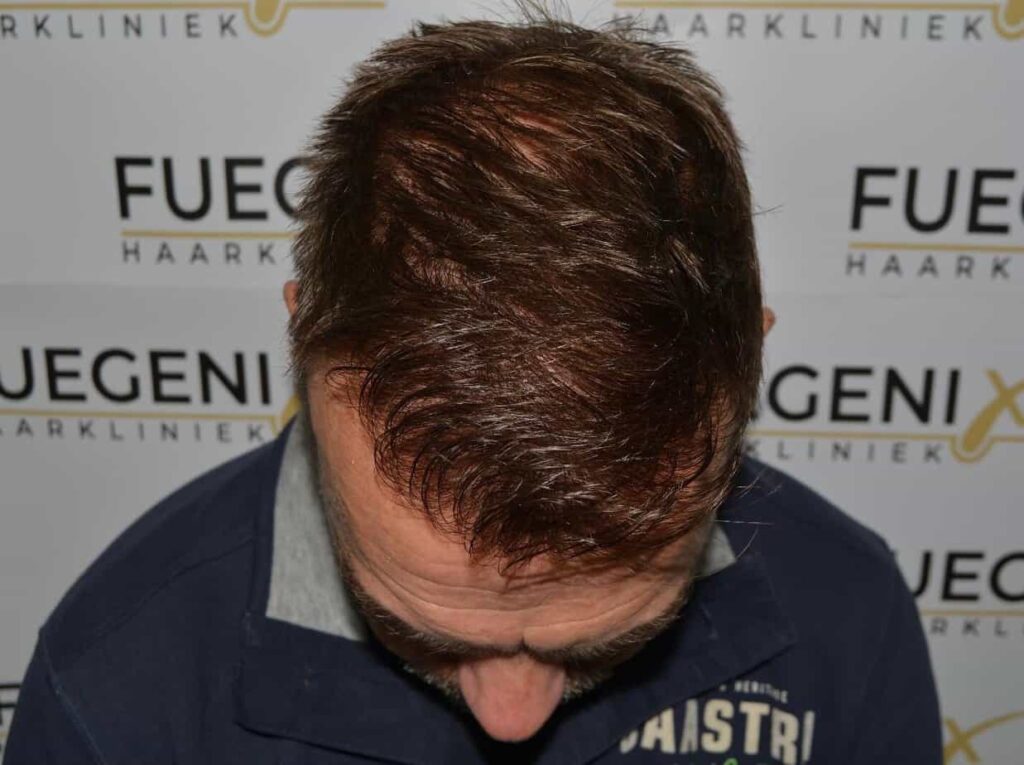 Hairline Artistry At Its Best