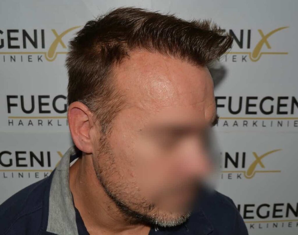 Hairline Artistry At Its Best