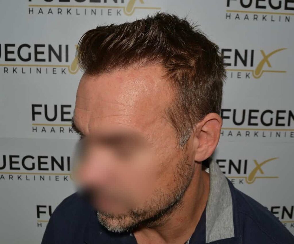 Hairline Artistry At Its Best