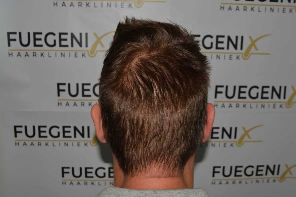 Hairline Artistry At Its Best