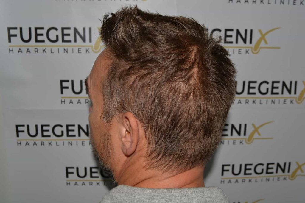 Hairline Artistry At Its Best