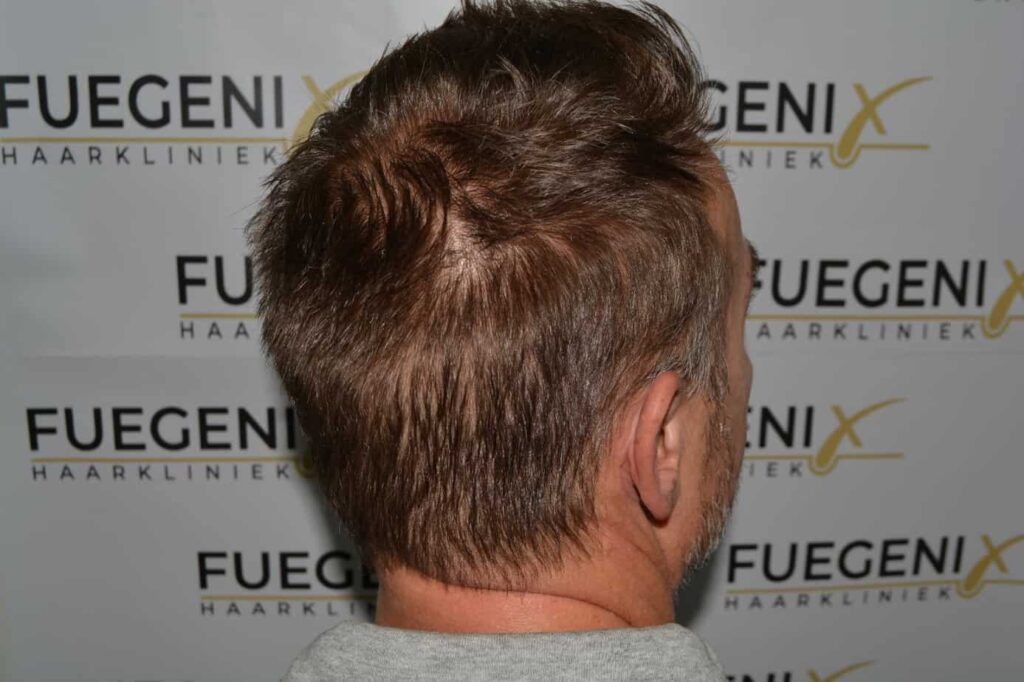 Hairline Artistry At Its Best
